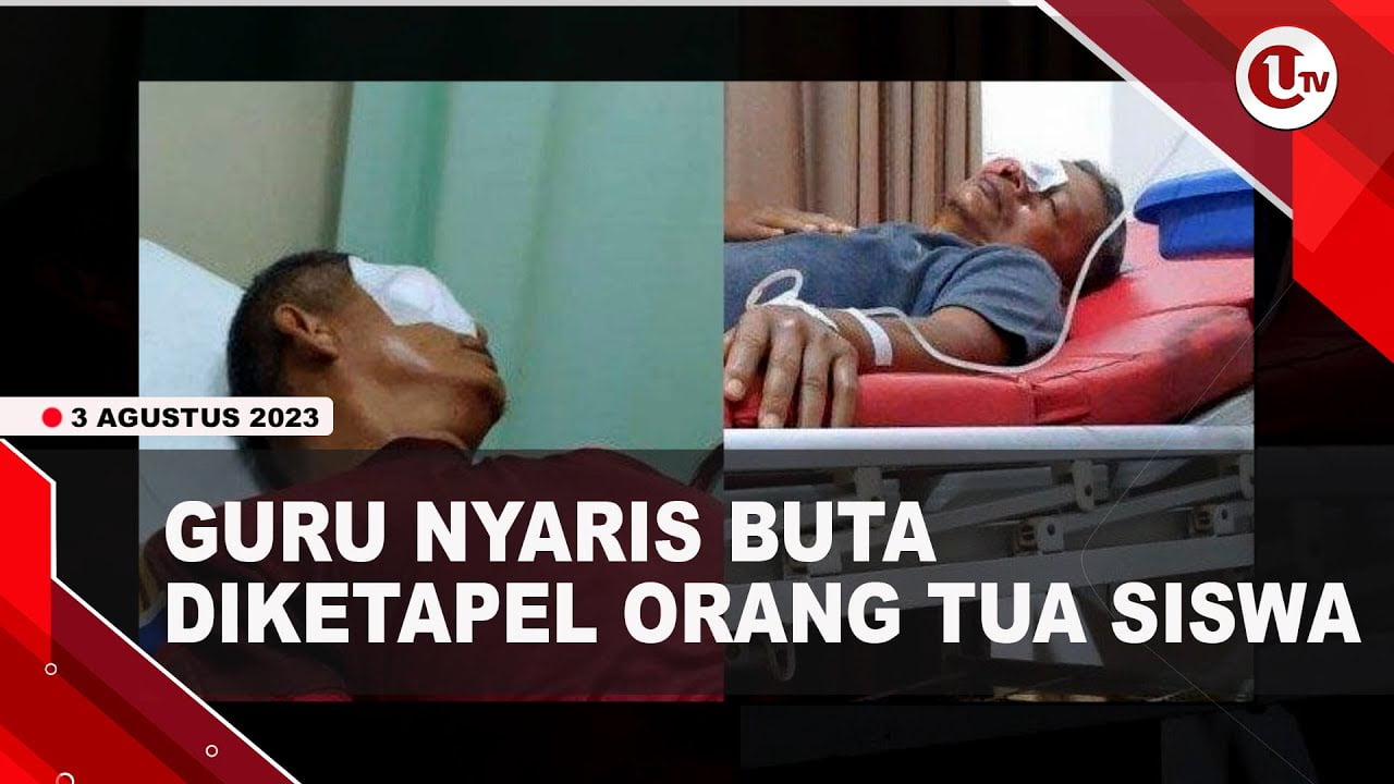 [Video] Guru SMA di Bengkulu Nyaris Buta Diketapel Orang Tua Siswa | U-NEWS