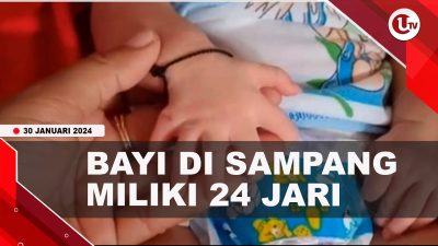 [Video] Bayi Perempuan di Sampang Miliki 24 Jari