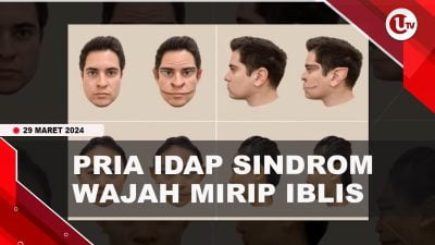 [Video] Pria Di AS Idap Sindrom ‘wajah Iblis’